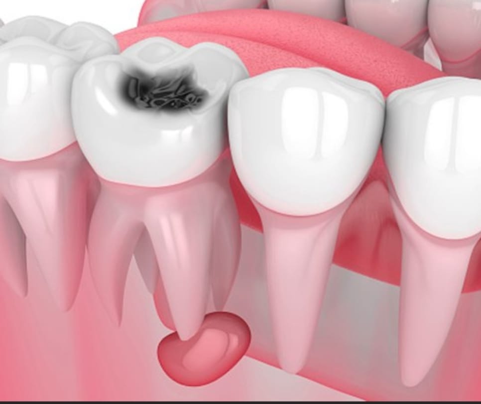 Oral cyst, tumor surgery